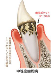 中度歯周炎