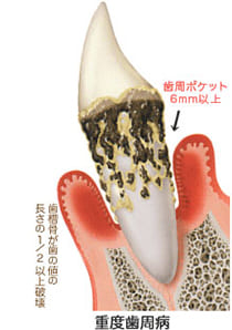 重度歯周炎