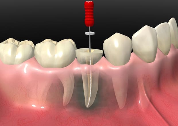 可能な限り歯を残す当院の根管治療